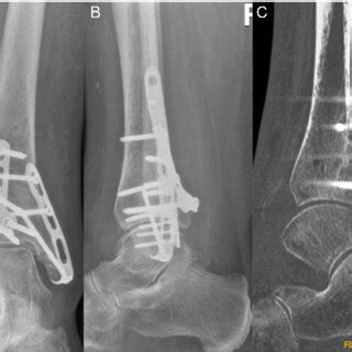 (A, B) X-ray 3 months after ORIF of PM with 3.5 mm T-Plate, ORIF fibula ...