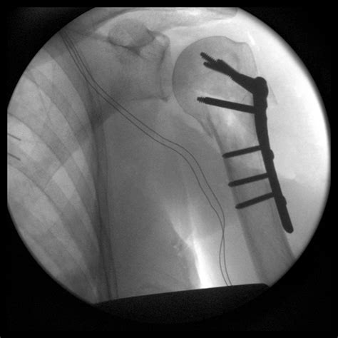 Proximal Humerus Fractures Artofit