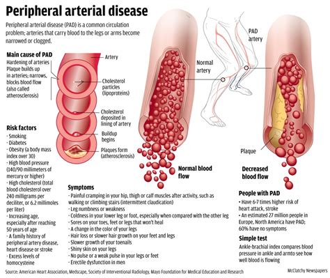 Peripheral Vascular Disease Wecare Germany