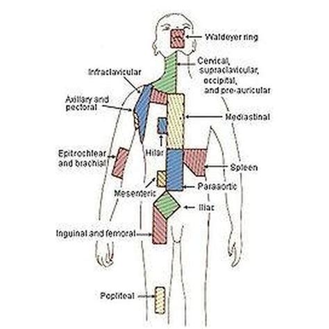 Cancer swollen lymph nodes - bitswest