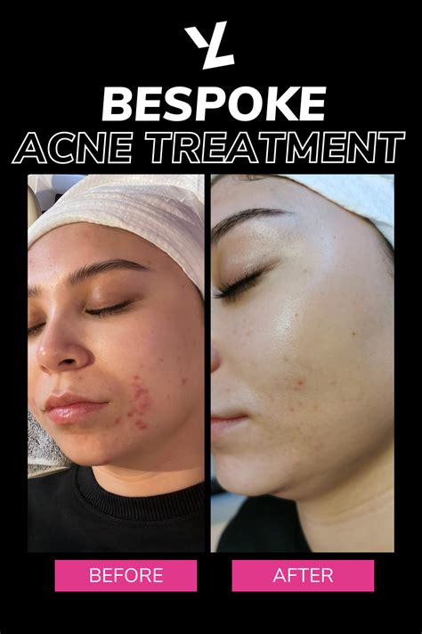 Bespoke Acne Facial Artofit