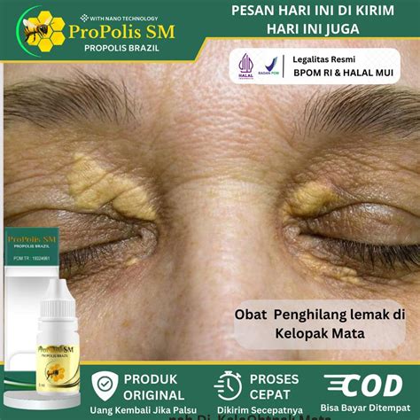 Jual Obat Hilangkan Lemak Di Kelopak Mata Pengendapan Kolesterol Di