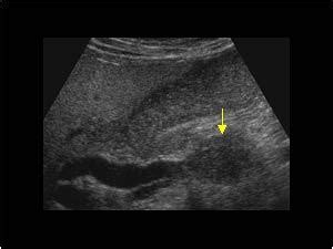 Pancreatic Adenocarcinoma Ultrasound