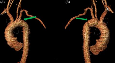 Anterior A And Posterior B Views Threedimensional Volume