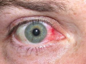 Episcleritis | Warwar Eye Group