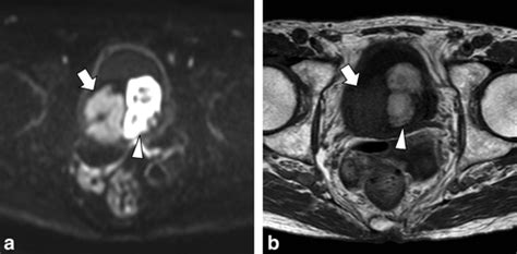 Mr Imaging Of Urinary Bladder Cancer For T‐staging A Review And A