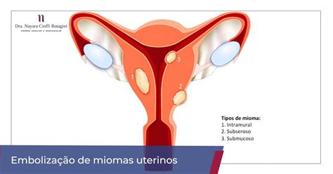 Miomas Uterino