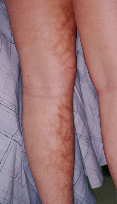 Bilateral Netlike Rash On The Lower Legs Clinical Advisor