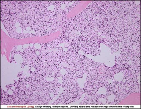 Hairy Cell Leukaemia CELL Atlas Of Haematological Cytology