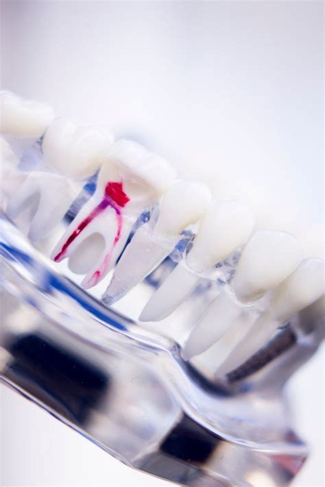 The Anatomy Of A Root Canal Dentist In Garland TX