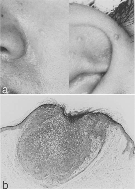 A Multiple Facial Trichilemmomas Macroscopic View Showing Milia Like