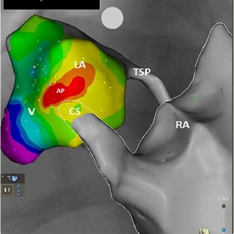 Anatomic Reconstruction Of A Left Sided Accessory Pathway Using