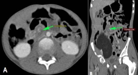 Coupe Axiale De Scanner Abdominal Inject Montrant L Art Re