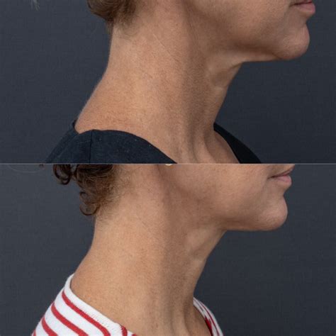 Myellevate Minimal Invasive Neck Lift Sydney Shape Clinic