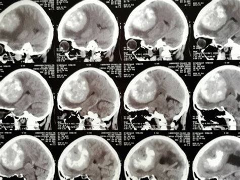 Día Internacional De Los Tumores Cerebrales ¿qué Los Provoca Y Cuál Es