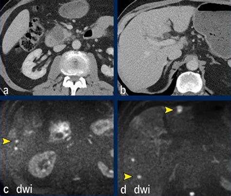 The Radiology Assistant Pancreatic Cancer Ct Staging 2 0