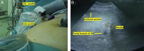 Percutaneous Transhepatic Portal Vein Puncture And Indocyanine Green