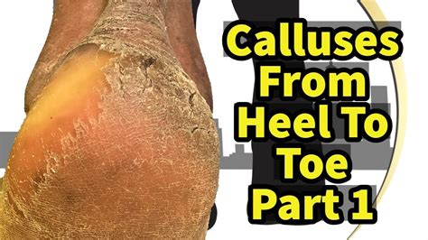 Calluses From Heel To Toe Part 1 The Heels YouTube