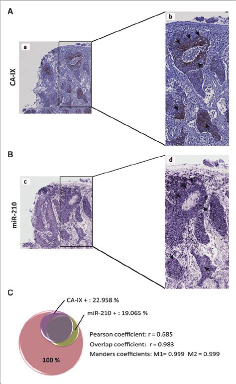 Hypoxia Induced Mir 210 Staining In Human Nsclc Tissues Colocalizes