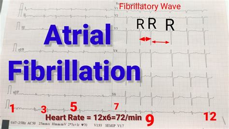 Af Ecg Interpretation Atrial Fibrillation In Ecg Af कि ईसीजी जानें How Calculate Heart Rate