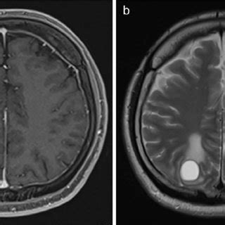 Cavernous Hemangioma Of The Skull Axial Mri In T Sequence Showing A