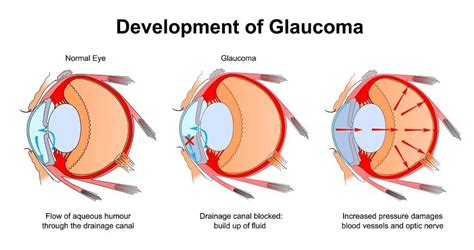 New Xen Gel Stent Is The Next Generation Treatment For Glaucoma