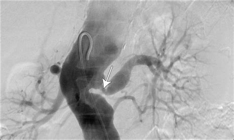 Fibromuscular Dysplasia Carotid Artery