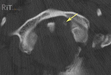 RiT radiology: Occipital Condylar Fracture