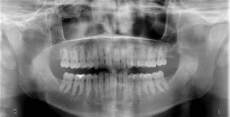 Anatomy Monday: Pterygomaxillary Fissure – Dr. G's Toothpix