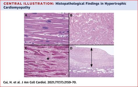 Myocardial Histopathology In Patients With Obstructive Hypertrophic