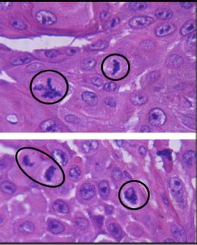 Pathology Flashcards Quizlet