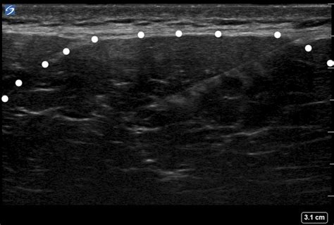 Ultrasound Guided Botulinum Toxin Injection For The Treatmen