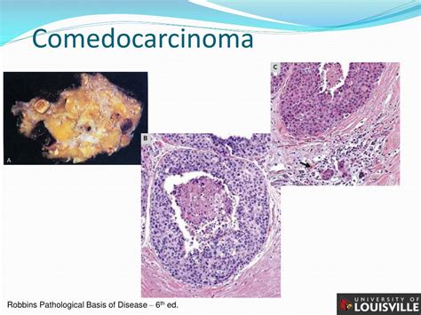 Ppt In Situ Carcinoma Of The Breast Powerpoint Presentation Free