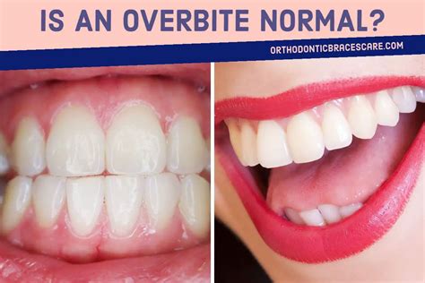 Is An Overbite Normal? How To Diagnose It? | Orthodontic Braces Care