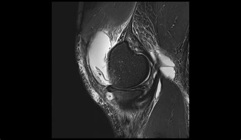 Baker's cyst rupture MRI | Radiology Article on Baker cyst rupture