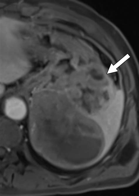 MRI Features Of Gastrointestinal Stromal Tumors AJR