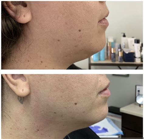 Agnes Precision Rf Microneedling Treatment Scottsdale