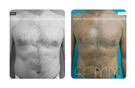 Pin En Ginecomastia Reducci N De La Mama En El Hombre Gynecomastia