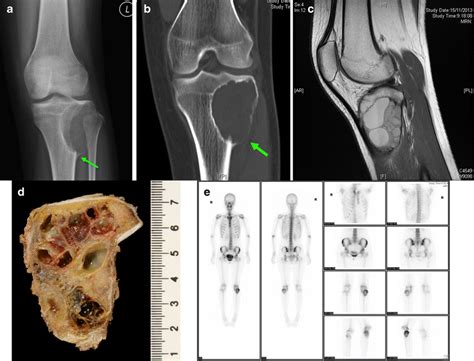 A Plain Radiograph Of Patient 5 Showing An Expansile Multiloculated Download Scientific Diagram