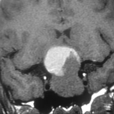 Note On This T1 Weighted Magnetic Resonance Imaging Coronal View A