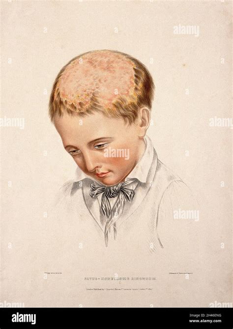 The Head Of A Boy With A Skin Disease Of The Scalp Coloured Lithograph