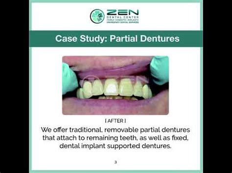 Zen Dental Case Study Implant Supported Partial Dentures YouTube