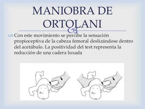 Displasia de cadera