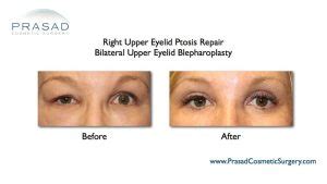 Can Upper Blepharoplasty Go Wrong Dr Prasad Blog