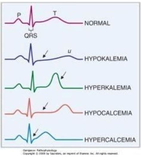 Hypokalemia Hyperkalemia Ecg