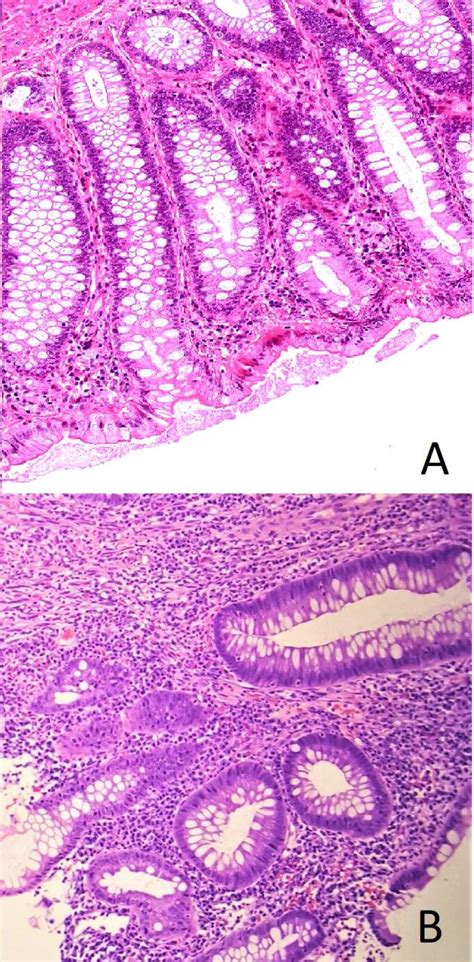 Hematoxylin And Eosin Staining Of Normal Rectal Biopsy In A Compared Download Scientific