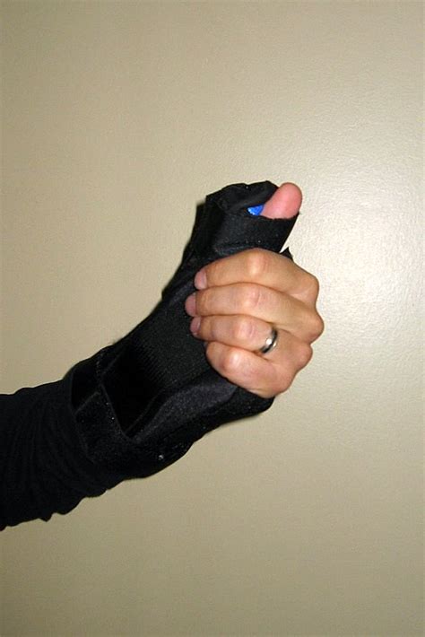 How To Treat A Sprained Thumb Physioroom Blog