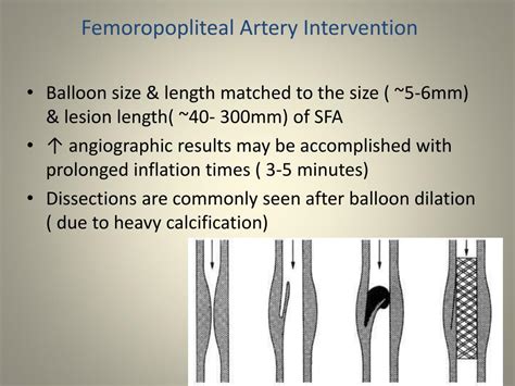 Ppt Peripheral Angioplasty Overview Hardware Powerpoint Presentation