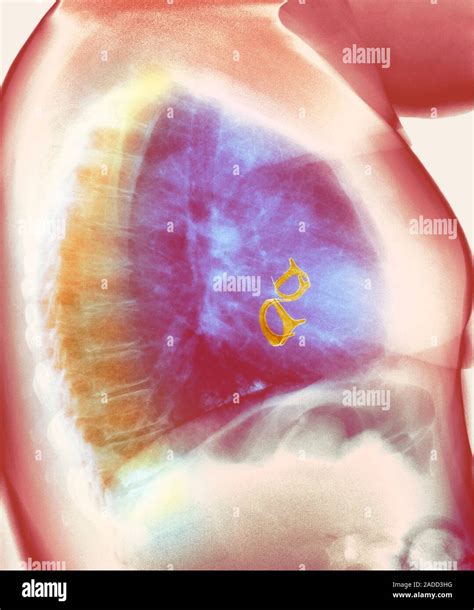 Mitral Valve Replacement Post Operative Coloured X Ray Of A Lateral