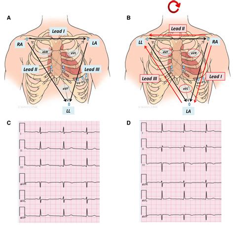 15 Lead Ecg Placement Diagram Ekg Basics Brown Pediatrics The